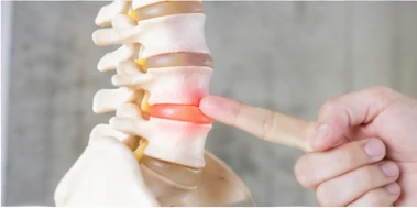 Disc Bulge & Slip Disc physiotherapy condition visual