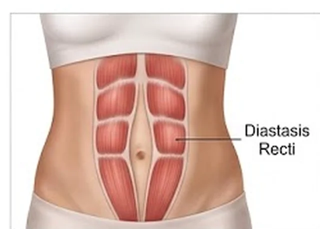 Diastasis Recti women’s health physiotherapy visual